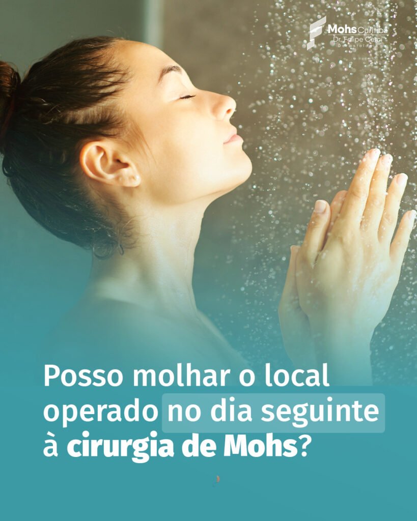 Posso molhar o local operado no dia seguinte à cirurgia de Mohs?