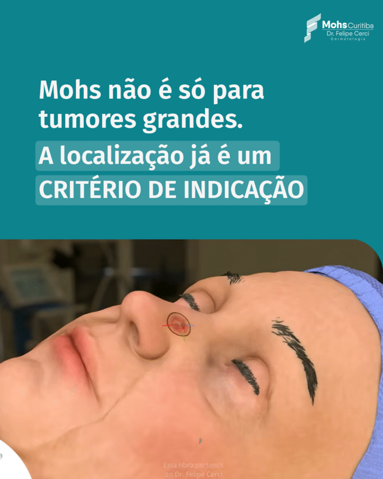 Mohs não é só para tumores grandes: por que a localização importa mais que o tamanho?