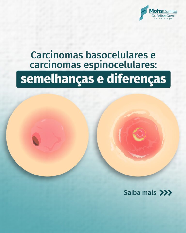 Ilustração de duas lesões de pele, com o título: carcinomas basocelulares e carcinomas espinocelulares, semelhanças e diferenças