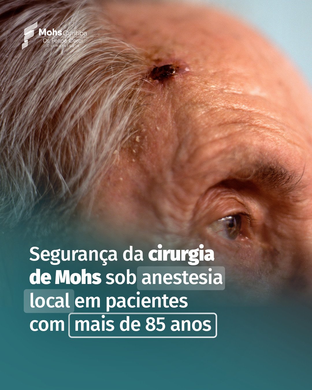 Senhor idoso com uma lesão na testa, com o título: segurança da cirurgia de Mohs sob anestesia local em pacientes com mais de 85 anos