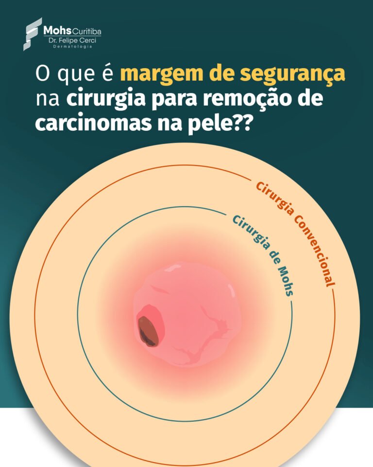 Ilustração comparando a margem retirada na cirurgia convencional, maior, e na cirurgia de Mohs, menor, ao redor de um carcinoma