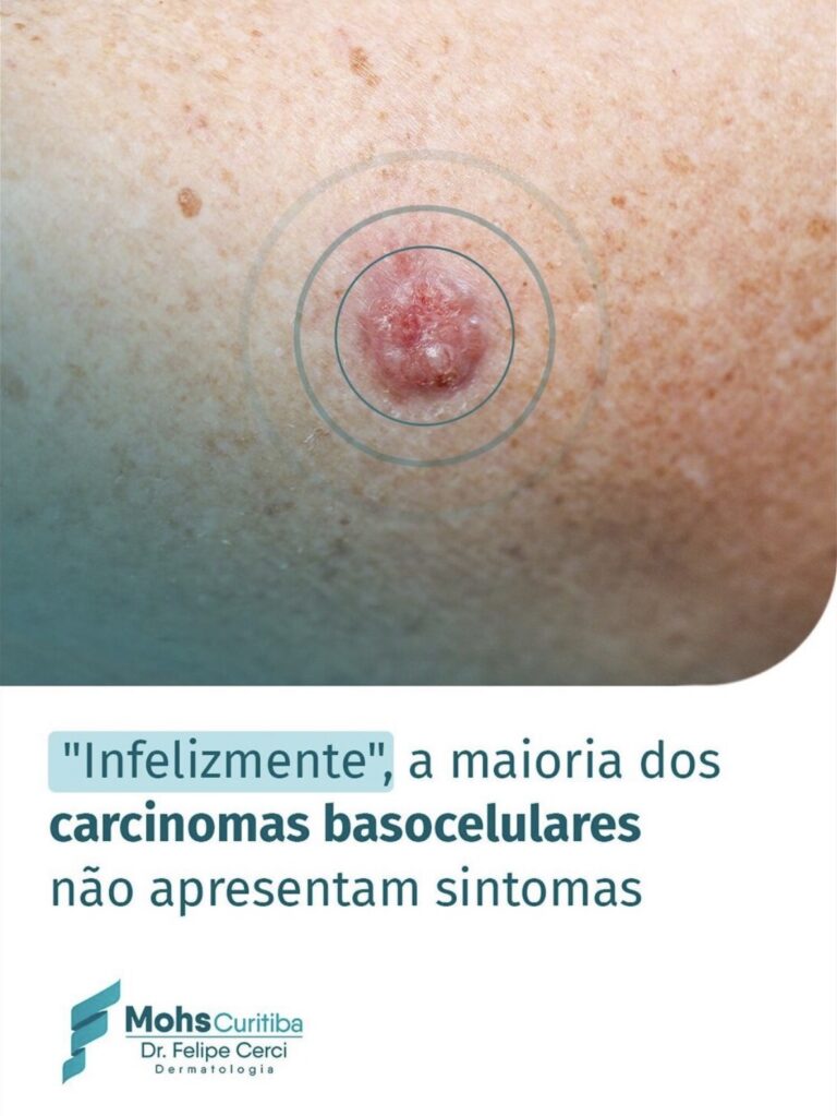 “Infelizmente” a maioria do carcinomas basocelulares não apresentam sintomas