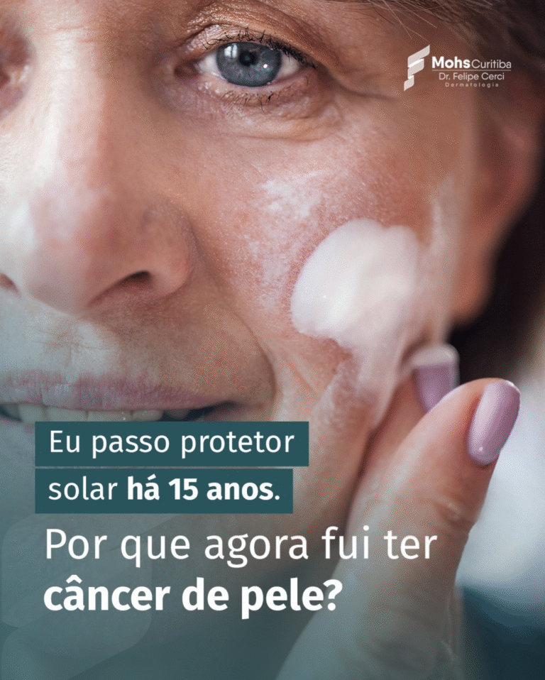 Eu passo protetor solar há 15 anos. Por que agora fui ter câncer de pele?