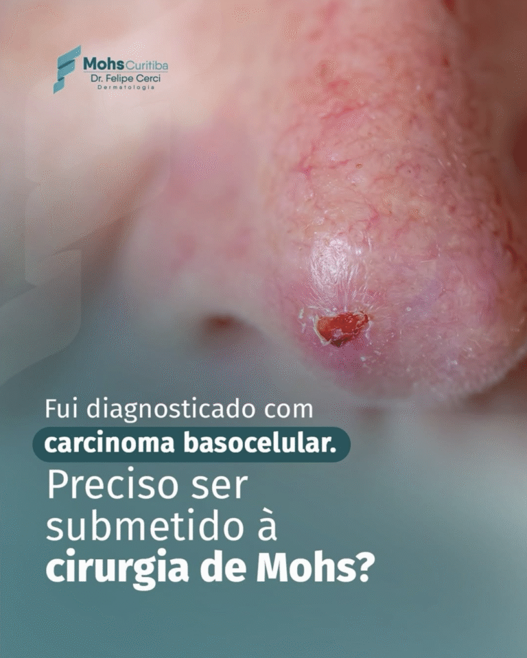 Fui diagnosticado com carcinoma basocelular. Preciso ser submetido à cirurgia de Mohs?