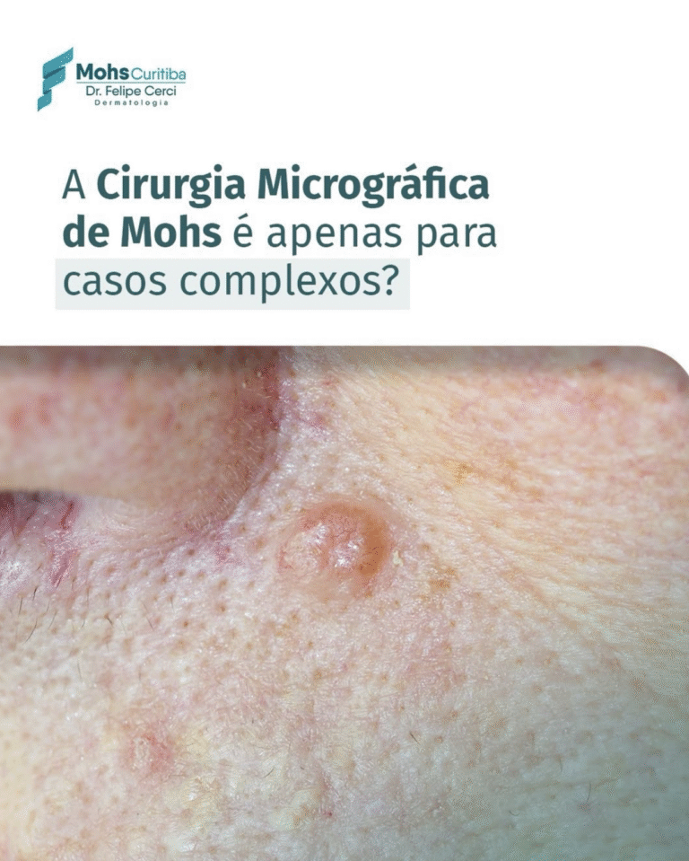 A Cirurgia Micrográfica de Mohs é apenas para casos complexos?
