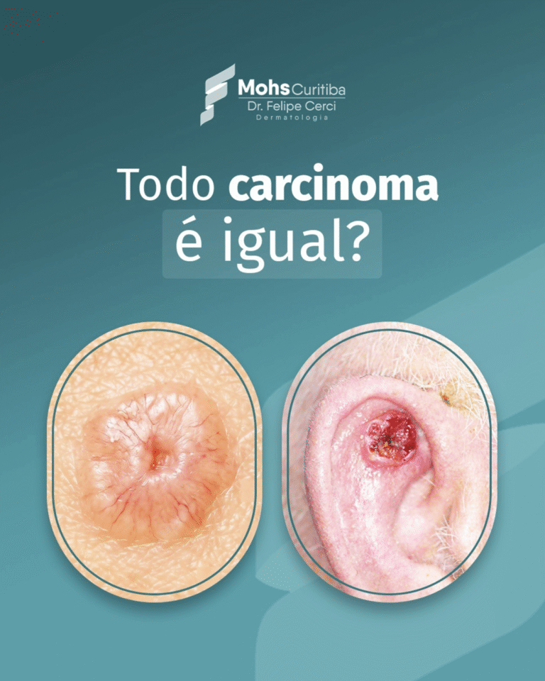 Todo carcinoma é igual?