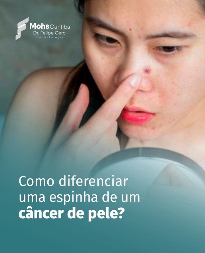 Mulher olhando no espelho uma lesão parecida com espinha no nariz, com a pergunta: como diferenciar uma espinha de um câncer de pele?