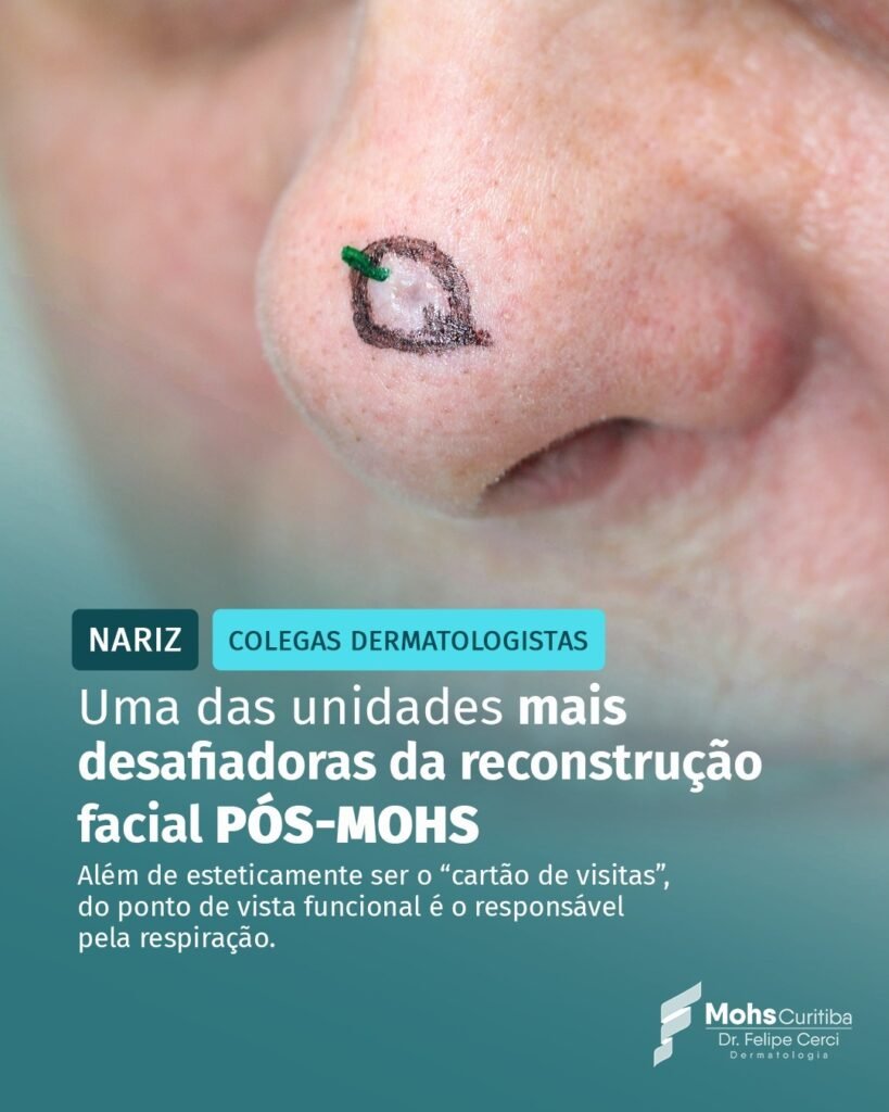 Nariz: uma das unidades mais desafiadoras da reconstrução facial pós-Mohs