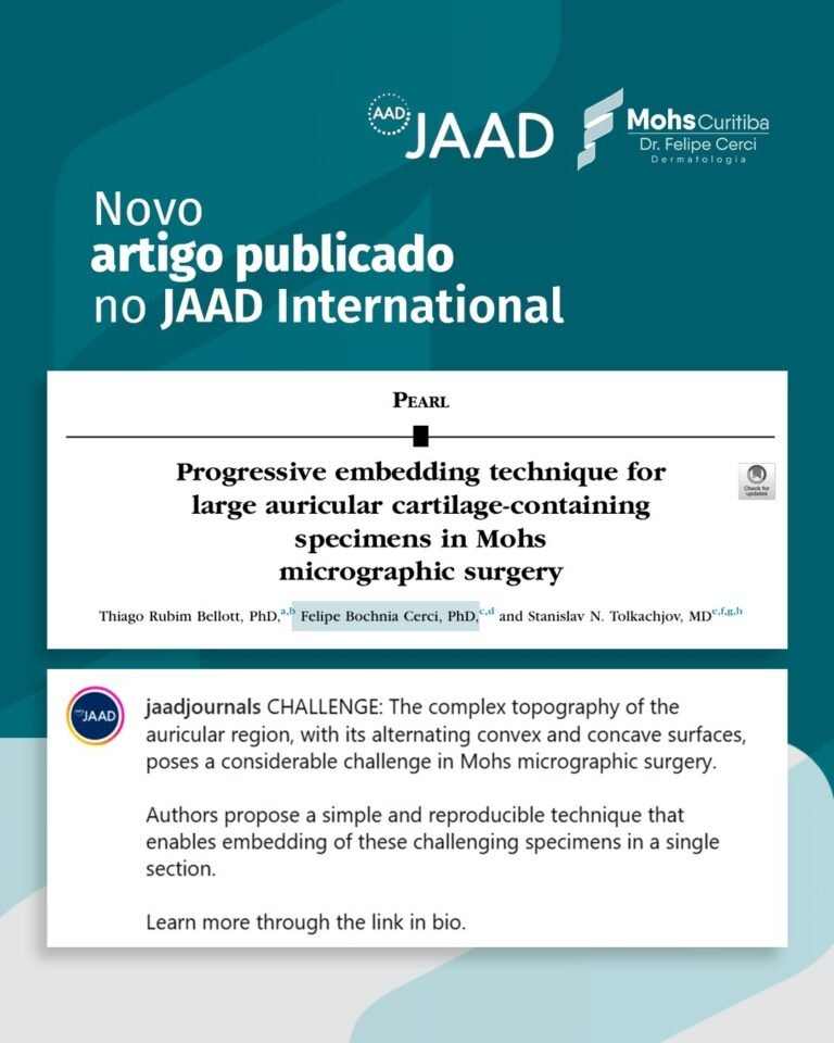 Novo artigo publicado no JAAD International: Progressive embedding technique for large auricular cartilage-containing specimens in Mohs micrographic surgery, de Thiago Rubim Bellott, Felipe Bochnia Cerci e Stanislav N. Tolkachjov